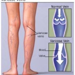 understanding_varicose_veins_basics
